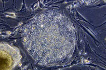 Пересаженные стволовые клетки превращаются в опухоли мозга